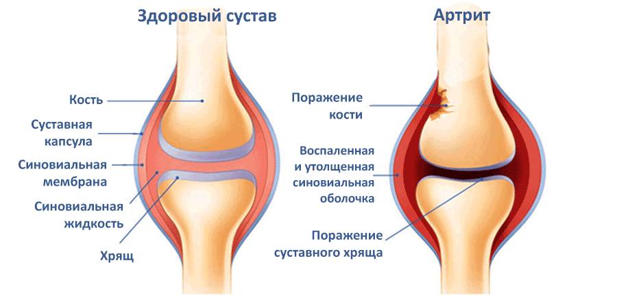 Средство от артрита